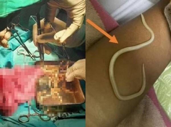 인도네시아의 한 3세 아이의 장에서 수십 마리의 기생충이 발견된 사례가 보고됐다./사진=영국 의학저널 사례 보고서