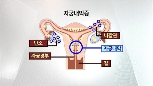 자궁내막증 [자료사진]