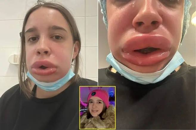 입술 필러를 제거하고 입술이 퉁퉁 부은 스페인 여성 사연이 공개돼 화제다.사진=SNS