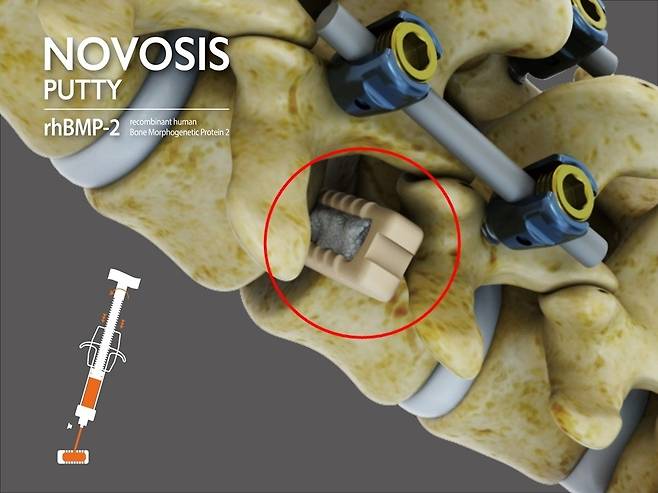 Generated image of Novosis Putty applied to a spinal fusion surgery (Daewoong Pharmaceutical)