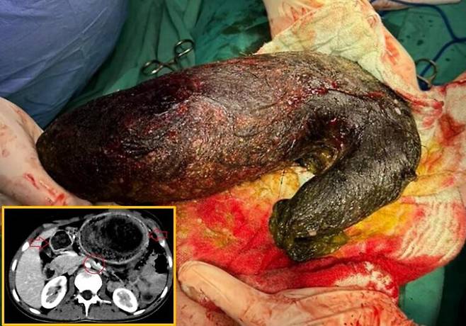 배 속에서 2kg에 달하는 머리카락 뭉치가 발견된 10대 여성의 사연이 소개됐다. [사진=SNS]