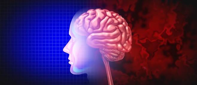 국내 연구진이 알츠하이머병의 진행과 밀접한 유전자 발현 변화를 규명하고 혈액 검사 기반의 조기 진단 가능성을 제시했다. 알츠하이머병을 나타낸 이미지. 게티이미지뱅크 제공