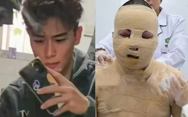 두준하오의 화상 입기 전(왼쪽)과 후(오른쪽) 모습./사진=홍콩 사우스차이나모닝포스트