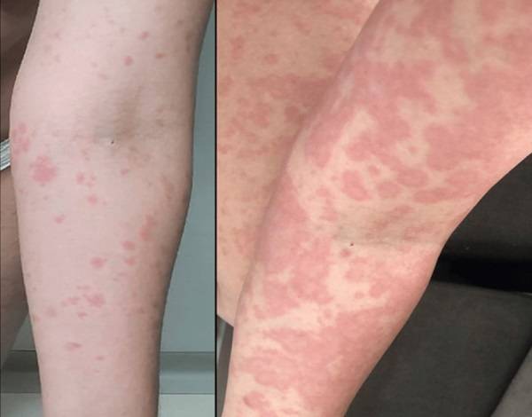 대마초 사용 후 피부에 알레르기 반응이 나타난 사례./사진=큐레우스