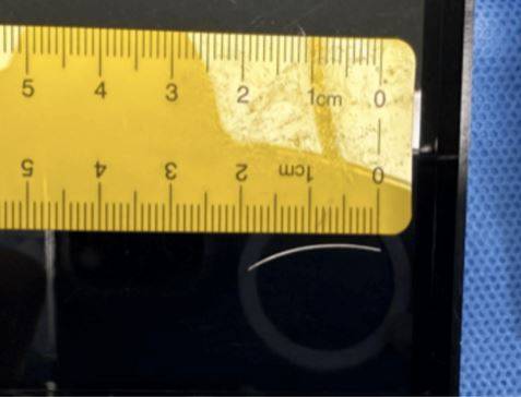 의료진이 남자아이의 하악골에서 제거한 깃털의 일부/사진=Cureus Journal of Medical Science