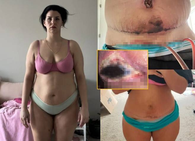 에리카 자코네는 2024년 2월, 복부 성형, 가슴 리프팅, 지방흡입을 포함한 일명 '마미 메이크오버(mummy makeover)' 수술을 받았다. 이후 예상치 못한 부작용 때문에 고통스러운 날들을 보낸 경험을 공유