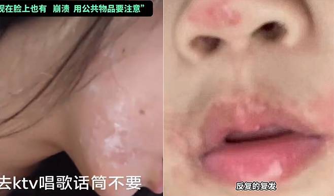 중국의 한 20대 여성이 노래방 마이크를 커버 없이 사용했다가 헤르페스 바이러스에 감염돼 8년째 고통을 받고 있다고 호소했다.  [웨이보 갈무리]
