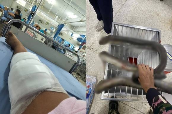 태국 여성 수핀 완펀(47)씨가 킹코브라(오른쪽)에 물린 상처. 페이스북 캡처