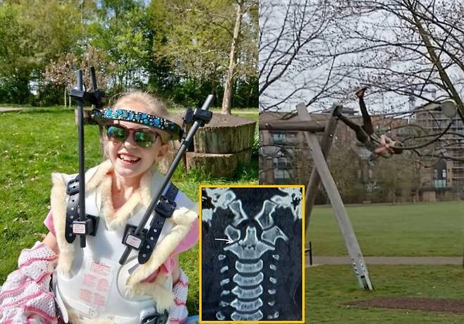 8세 여아가 짚라인을 타다 떨어져 목뼈가 골절되는 사고가 발생했다. [사진=SNS]