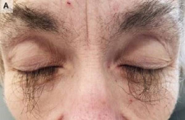 미국의 한 50대 여성이 항암제를 복용한 후 부작용을 겪고, 악성 전이로 인해 사망한 사례가 공개됐다./사진=영국의학저널