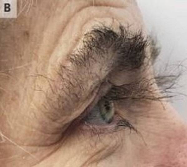 속눈썹 길어진 50대 여성의 모습./사진=영국의학저널