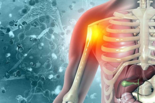 만성 통증 질환인 섬유근육통 환자에게 건강한 사람의 장내 미생물을 투여하자 통증과 불안, 수면장애가 완화됐다는 임상시험 결과가 발표됐다. 근육통을 표현한 이미지. 게티이미지뱅크 제공