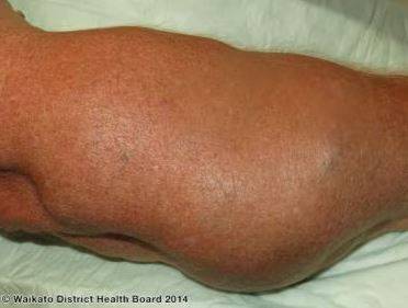 팔에 커다란 지방종이 생긴 더컴병 환자/사진=Medscape