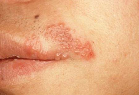 헤르페스 바이러스 감염 시 증상./사진=질병관리청 국가건강정보포털