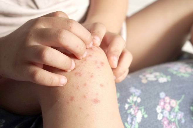 장내 미생물은 피부 질환에도 영향을 미친다. 게티이미지뱅크 제공