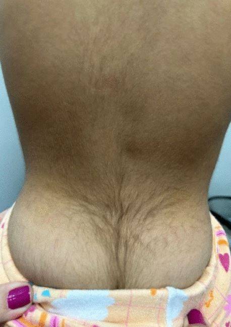 성장 촉진 주사 치료 9개월 후 다모증이 나타난 아이의 뒷모습./사진=BMC-Part of Springer Nature