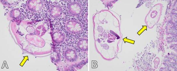 급성 충수염 증상을 보이던 15세 여성의 몸에서 요충이 발견된 사례가 보고됐다. [사진=Cureus]