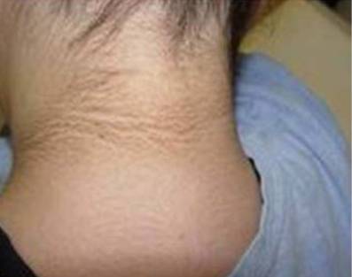 흑색가시세포증 증상. 사진=순천향대서울병원