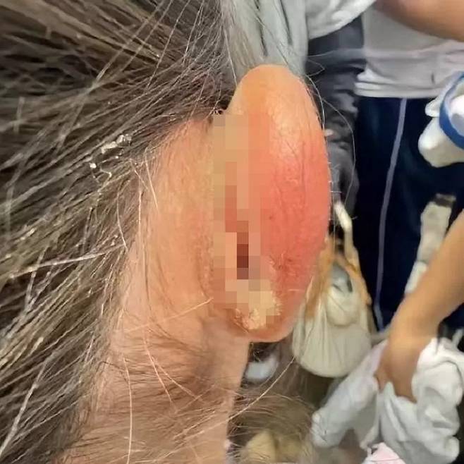 중국의 한 초등학교에서 교사가 수업에 집중하지 않는다는 이유로 제자의 귀를 잡아 당겨 피부가 찢어지는 사건이 발생했다. [중국 화상보대풍신문]