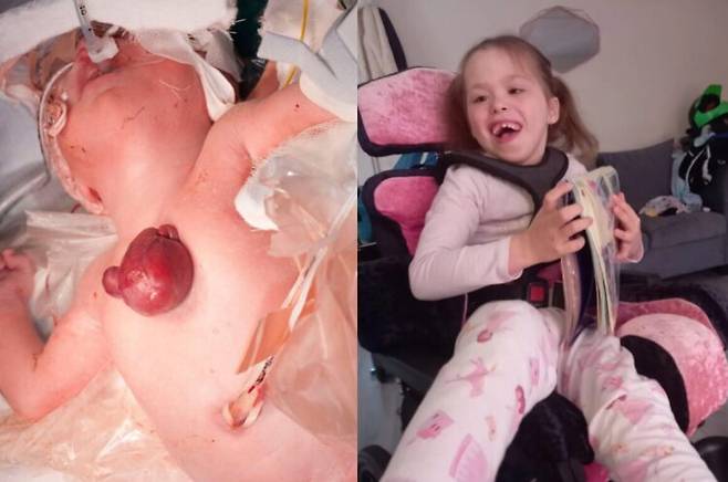 심장이 몸 밖에 노출된 채 태어난 소녀가 7년간의 의료적 준비 끝에 혁신적인 흉부 재건 수술에 성공했다. [사진=영국 레스터 글렌필드 병원]