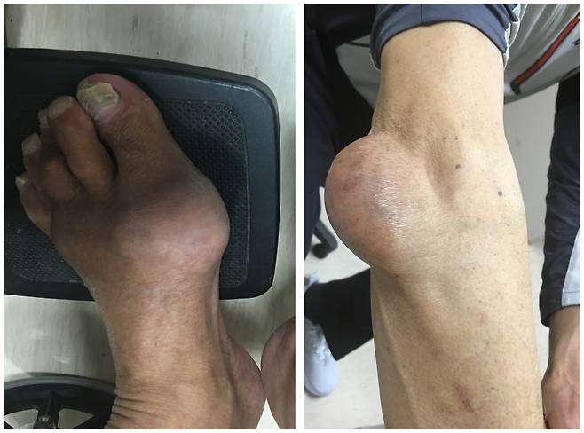 지난해 통풍 치료를 위해 제주대병원을 찾은 A씨의 발 모습(왼쪽)과 팔에 통풍이 생긴 환자 사진. 강병주 제주대병원 류마티스내과 교수 제공