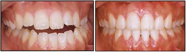 교정으로 치아의 비대칭이 잘 교정된 예입니다. [사진=Am J Orthod Dentofacial Orthop 2016;150:1028]