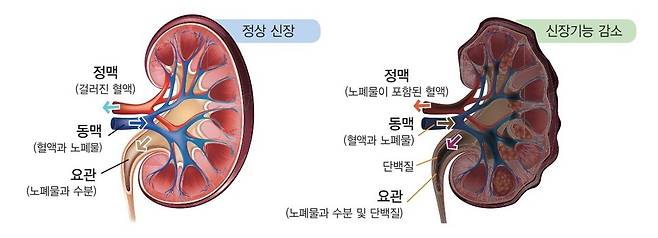 정상 신장과 기능이 감소된 신장 모습. 서울대병원 제공