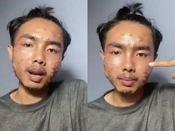 외국의 한 남성이 옷을 빨지 않고 입었다가, 얼굴에 수십 개의 혹이 생긴 일화를 공개해 화제다./사진=니드투노우