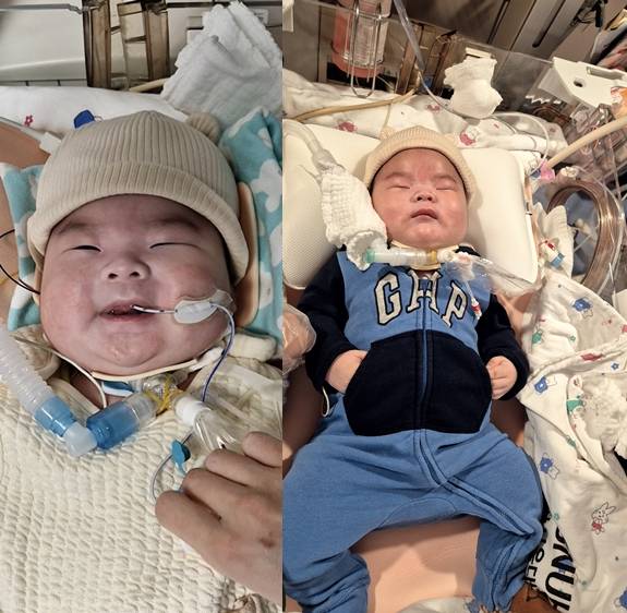 지난 2월 경기도 성남시 분당서울대병원 중환자실에 입원해 있는 윤솔(0)군의 모습. 오른쪽은 지난달 18일의 모습. 안지은씨 제공