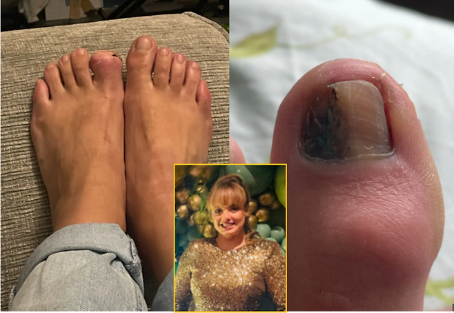 그냥 멍인 줄 알았던 발톱 밑 얼룩이 알고 보니 생명을 위협하는 피부암이라는 진단을 받고 엄지 발가락 일부를 잘라낸 여성의 사연의 공유됐다. [사진=SNS]
