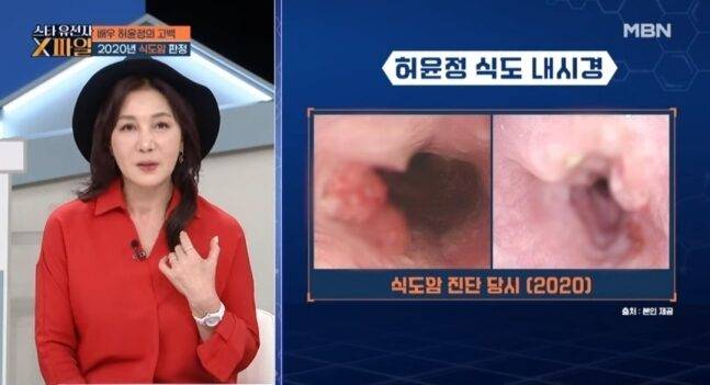 배우 허윤정이 식도암을 진단받고 식도 24cm를 절제한 사실을 고백했다. [사진=MBN '임성훈의 스타 유전자X파일']