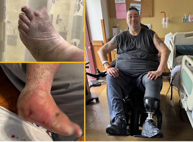 한 남성이 아내와 스파에서 페디큐어를 받다 발가락이 베인 후 치명적이 감염으로 인해 다리를 절단해야 했던 사연이 공유됐다. [사진=SNS]