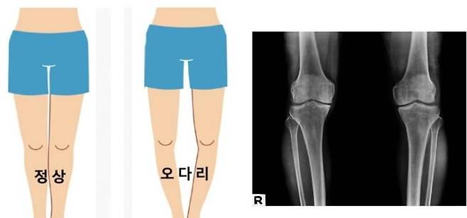 오다리는 퇴행성 관절염을 일찍 불러오는, 또 다른 원인이기도 하다. [사진=부산큰병원]