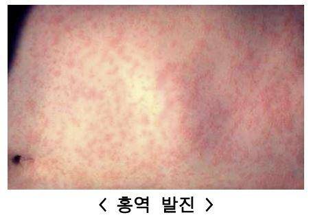 홍역 발진 증상 [질병관리청 제공]