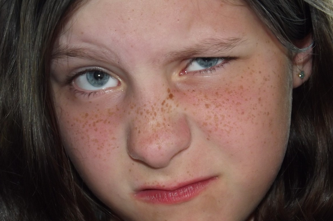 주근깨