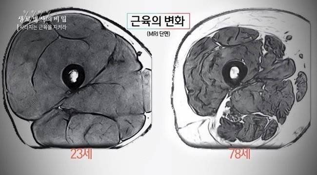 20대와 70대의 허벅지 단면 차이
