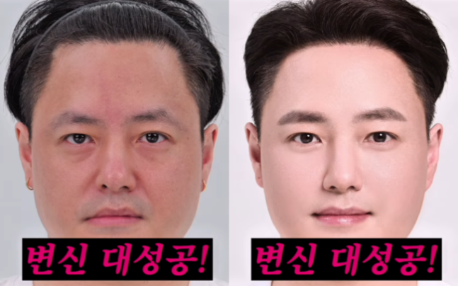 노유민이 모발이식에 이어 눈 밑 지방재배치 시술로 전성기 비주얼을 되찾았다. 노유민 인스타그램 갈무리