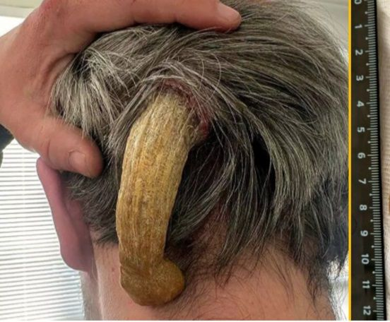 남성의 머리에 각질종이 길게 자라나 있다. [사진 = 미러]