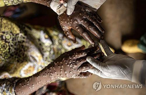 콩고민주공화국 엠폭스 환자의 손 [EPA 연합뉴스 자료사진. 재판매 및 DB 금지]