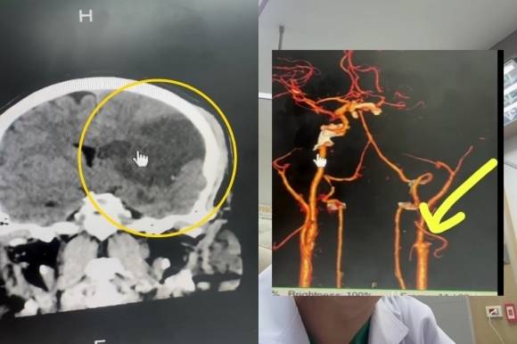 아내의 잘못된 마사지로 경동맥이 끊어져 뇌 일부가 손상된 환자. 페이스북 캡처