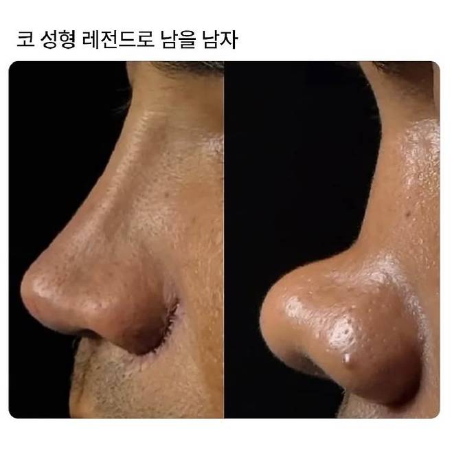 309977FF-049E-420D-92BE-0928BEDCC63A.jpeg 레전드 코 성형수술. jpg