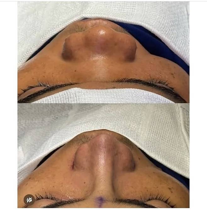 412D5BD7-3466-44F5-879D-4C6ECCAFC7E5.jpeg 레전드 코 성형수술. jpg