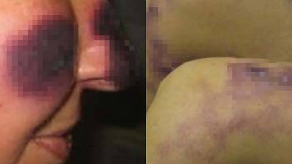 괴사된 여성의 피부//사진=캐나다 의학 협회지​