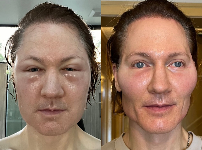 미국 억만장자 ‘브라이언 존슨’이 레누바를 맞고 생긴 부작용을 공개했다. [사진 = 브라이언 존슨 인스타그램]