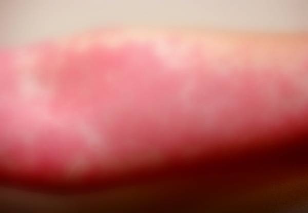 특정 음식이나 약물에 알레르기가 나타나는 경우가 있는데, 희귀하게 물에 알레르기 반응을 보이는 사례가 공개됐다./사진=사이언스 다이렉트 저널