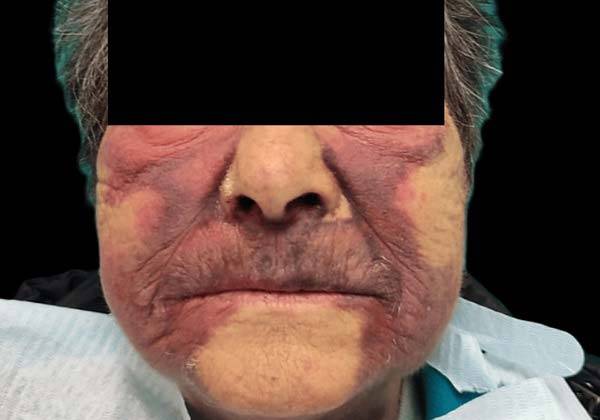 임플란트 수술 중 과다 출혈이 발생해 얼굴뿐 아니라 목까지 멍이 든 80세 여성의 얼굴./사진=큐레우스