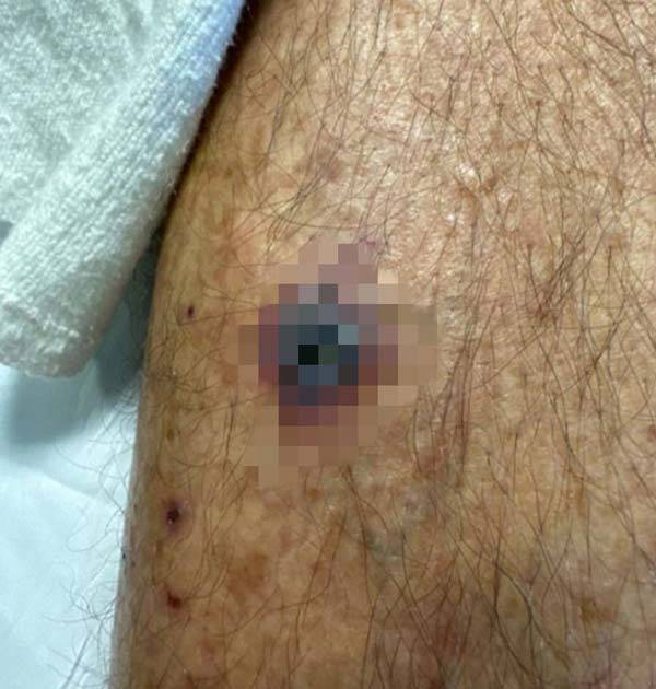 미국 60대 남성이 반려견이 상처 부위를 핥은 뒤부터 상처가 까맣게 변하고 건강이 악화했다./사진=미국사례보고저널