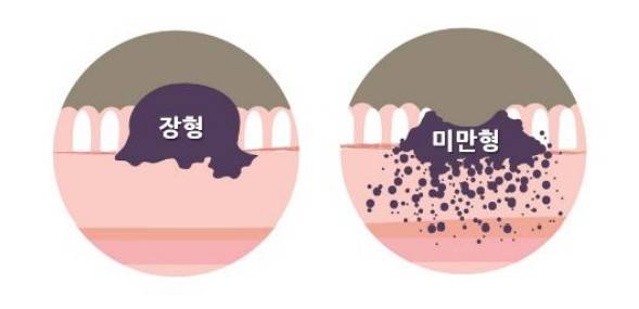 덩어리 형태의 장형 위암(왼쪽)과 점막을 따라 퍼지듯 분포해 조기 발견이 어렵고 예후도 좋지 않은 미만형 위암. 분당서울대병원 제공