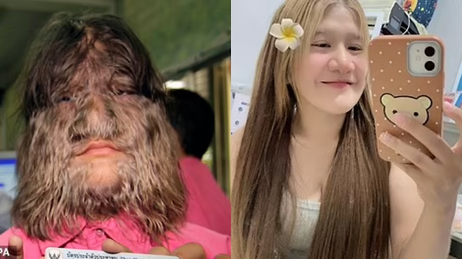 세계에서 가장 털이 많은 여자로 기네스북에 올랐던 태국 방콕 출신인 수파트라 서스판(25). [사진 = EPA/페이스북]