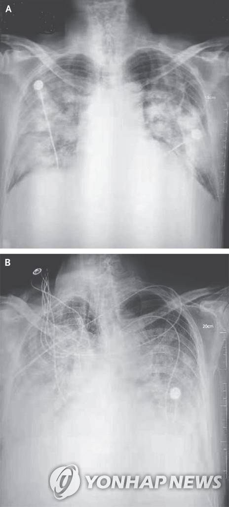 우한 폐렴 환자의 흉부 방사선 사진 [NEJM 논문 발췌]